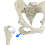 Hip Dislocation