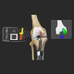 Mako Robotic-Arm Assisted Technology for Partial Knee Replacement
