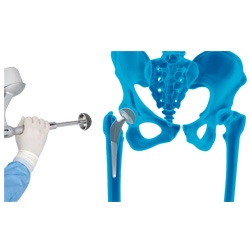 Mako Robotic-Arm Assisted Technology for Total Hip Replacement