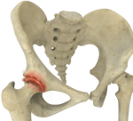 Osteoarthritis of the Hip