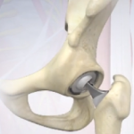 Posterior Hip Replacement