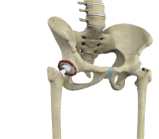 Revision Hip Replacement